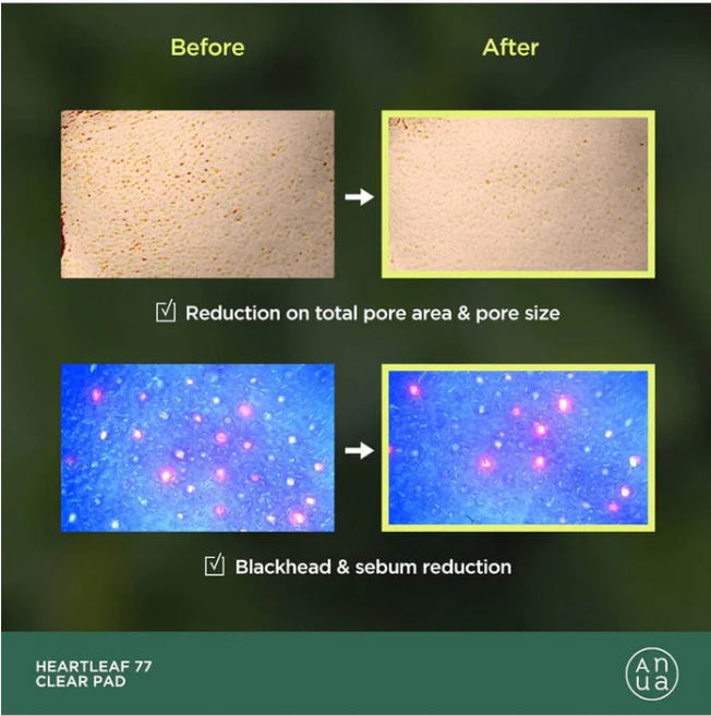 Anua Heartleaf 77% Clear Pad for soothing and pore-tightening